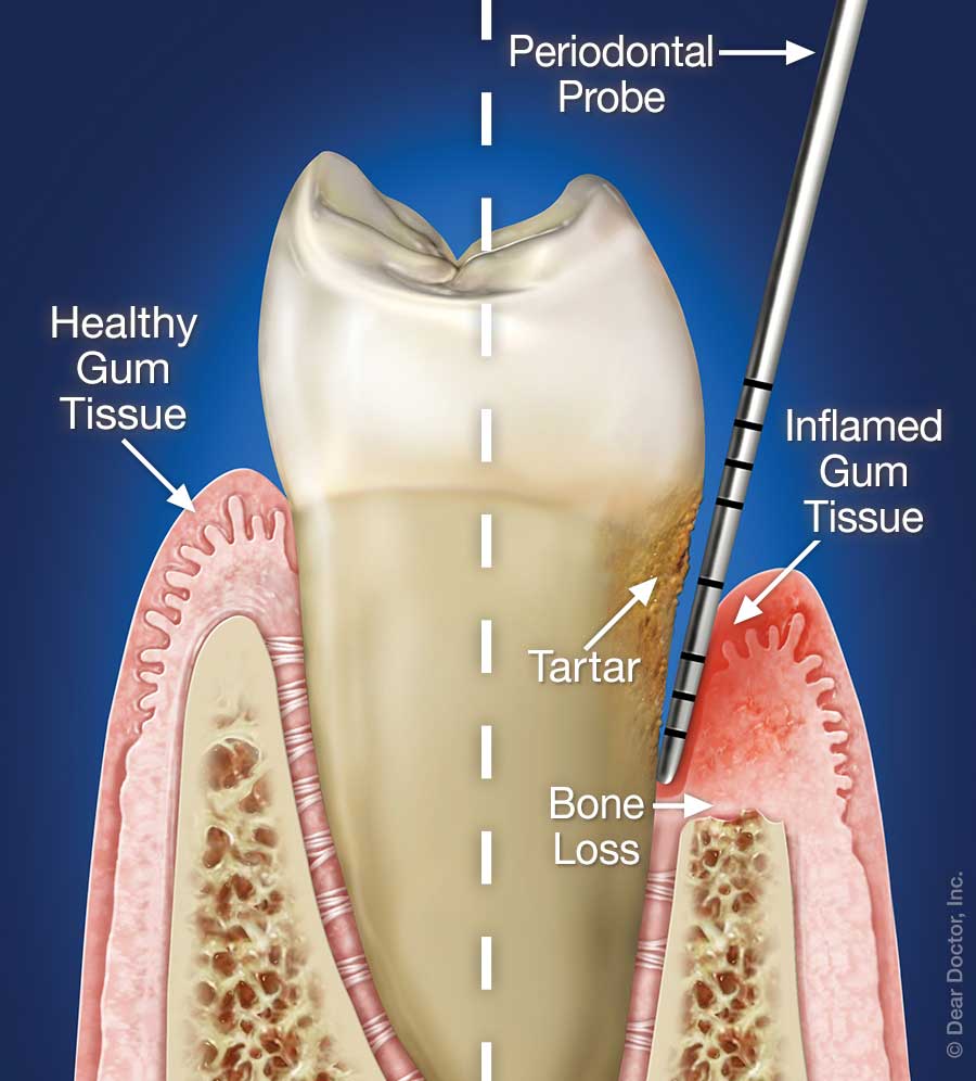 List Of Periodontal Therapy Procedures You Should Know