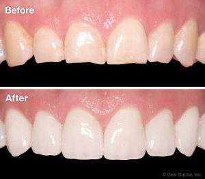 Versatility of Veneers - Before and After
